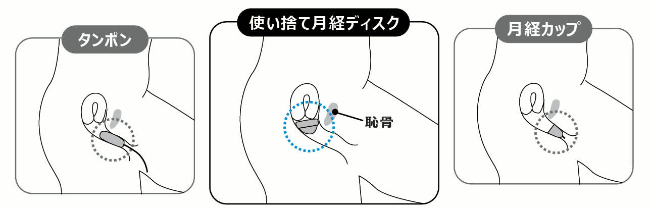 タンポン、月経ディスク、月経カップの装着位置の比較