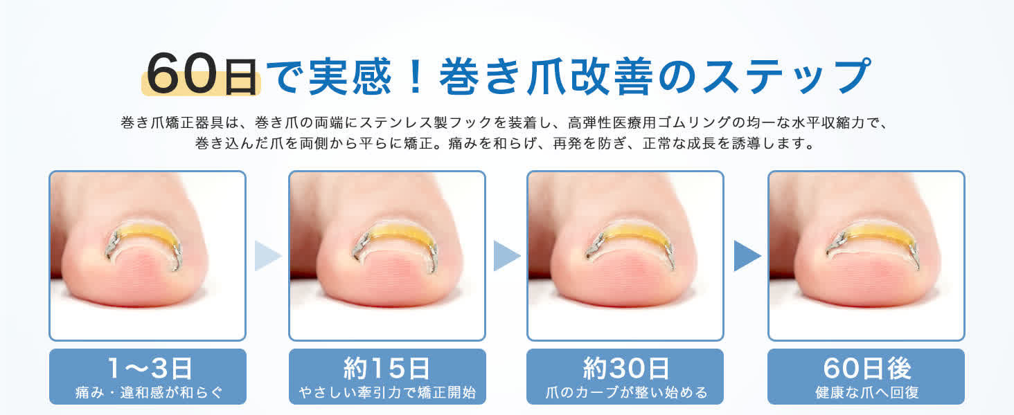 60日で実感する巻き爪改善ステップと爪の変化